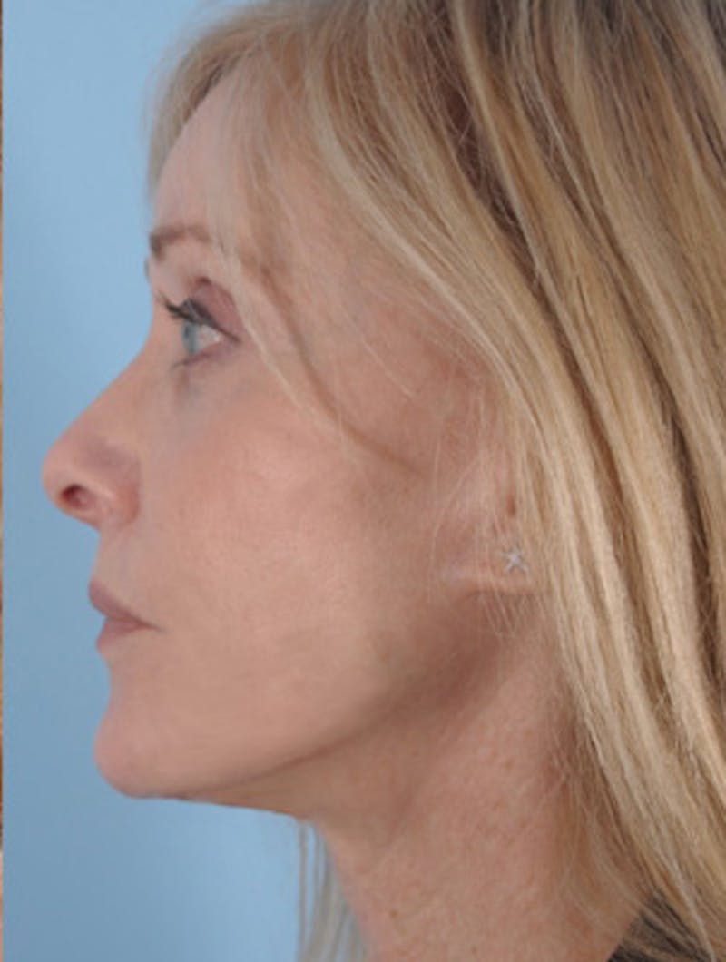 Neck Lift Before & After Gallery - Patient 176310 - Image 2