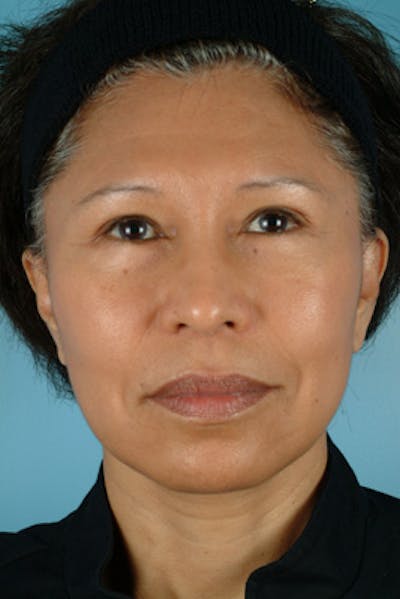 Upper Blepharoplasty Before & After Gallery - Patient 292855 - Image 1