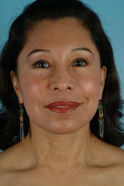 Upper Blepharoplasty Before & After Gallery - Patient 292855 - Image 2
