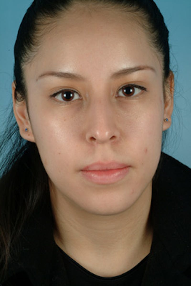 Rhinoplasty Before & After Gallery - Patient 235038 - Image 3
