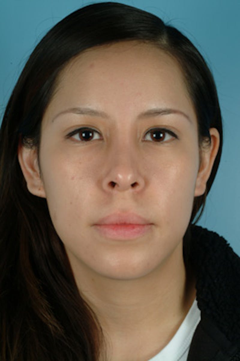 Rhinoplasty Before & After Gallery - Patient 235038 - Image 4