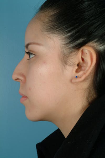 Rhinoplasty Before & After Gallery - Patient 235038 - Image 1