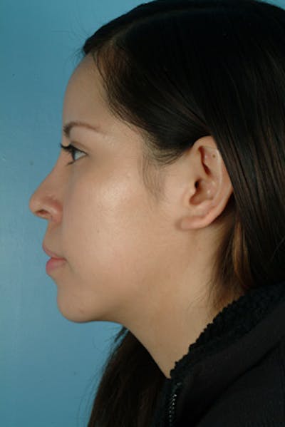Rhinoplasty Before & After Gallery - Patient 235038 - Image 2