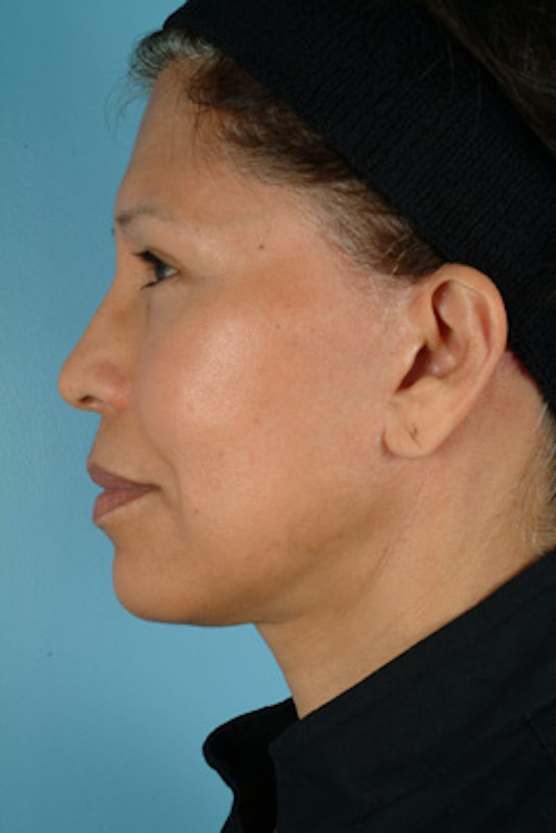 Upper Blepharoplasty Before & After Gallery - Patient 292855 - Image 5