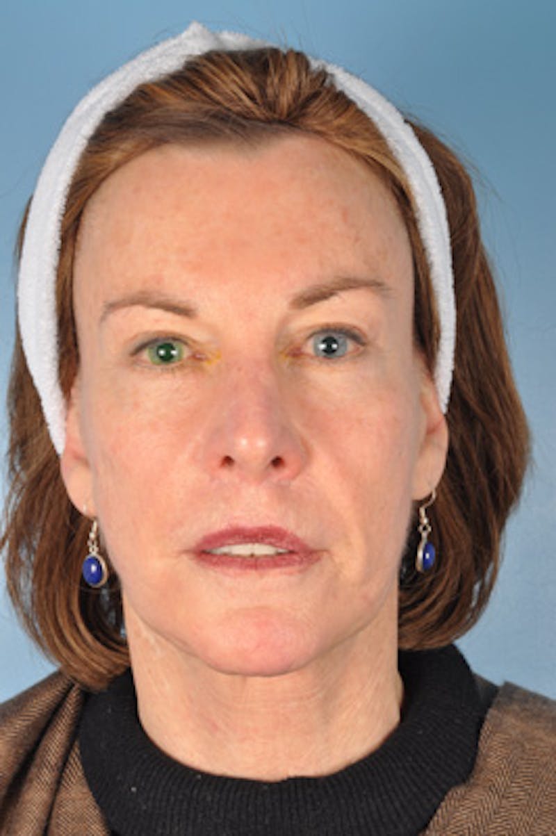 Neck Lift Before & After Gallery - Patient 394128 - Image 3