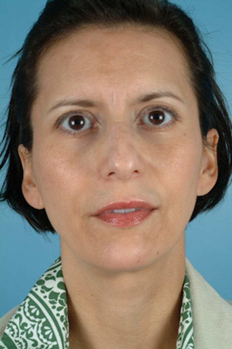 Rhinoplasty Before & After Gallery - Patient 252891 - Image 3