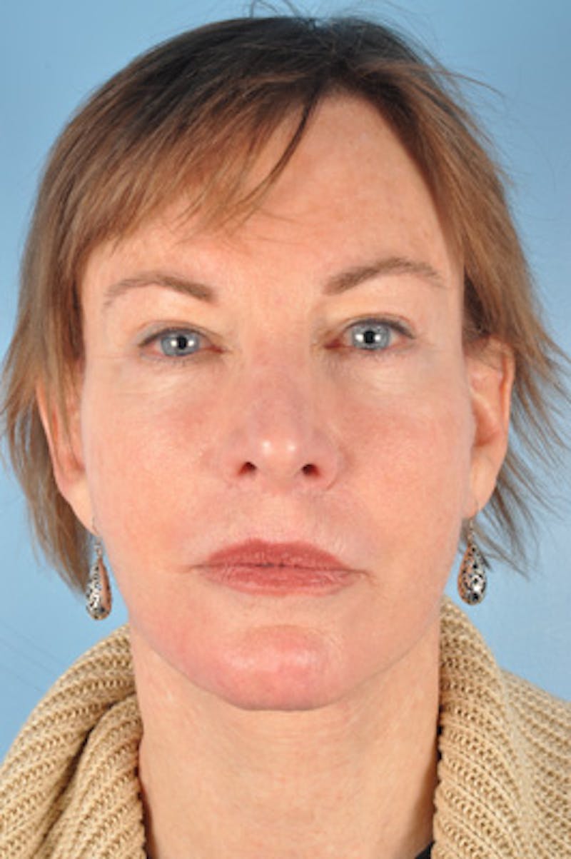 Neck Lift Before & After Gallery - Patient 394128 - Image 4