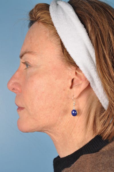 Neck Lift Before & After Gallery - Patient 394128 - Image 1