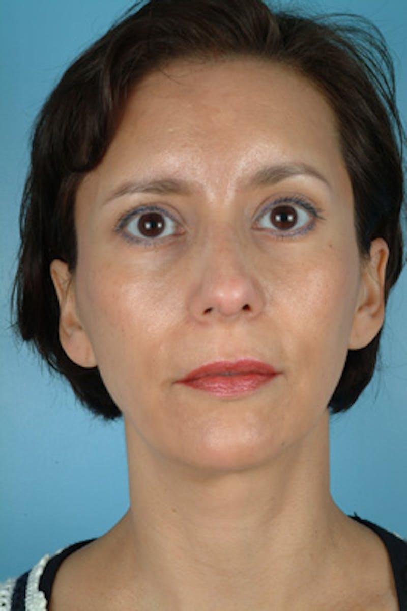Rhinoplasty Before & After Gallery - Patient 252891 - Image 4