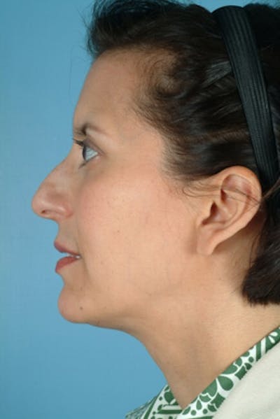 Rhinoplasty Before & After Gallery - Patient 252891 - Image 1
