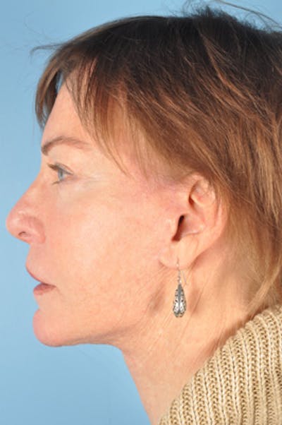 Neck Lift Before & After Gallery - Patient 394128 - Image 2