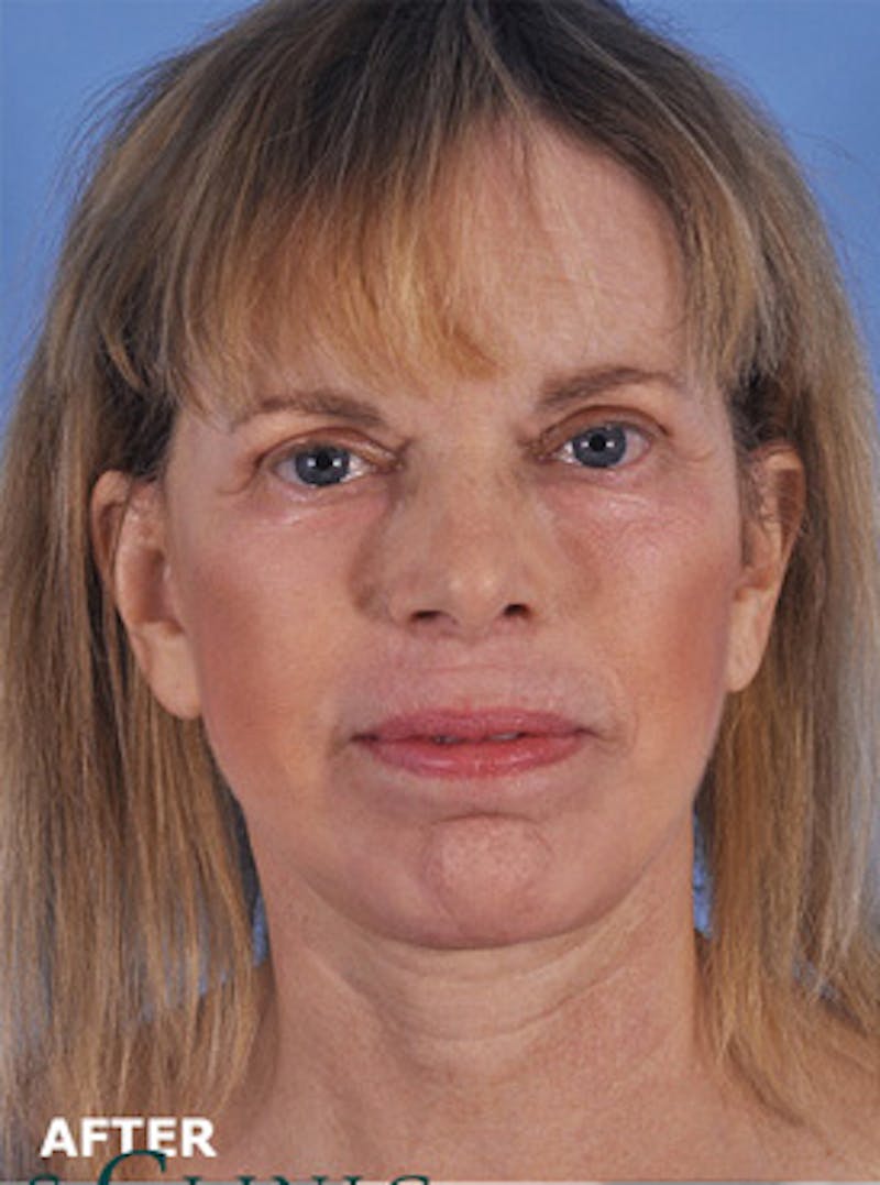 Neck Lift Before & After Gallery - Patient 380597 - Image 4