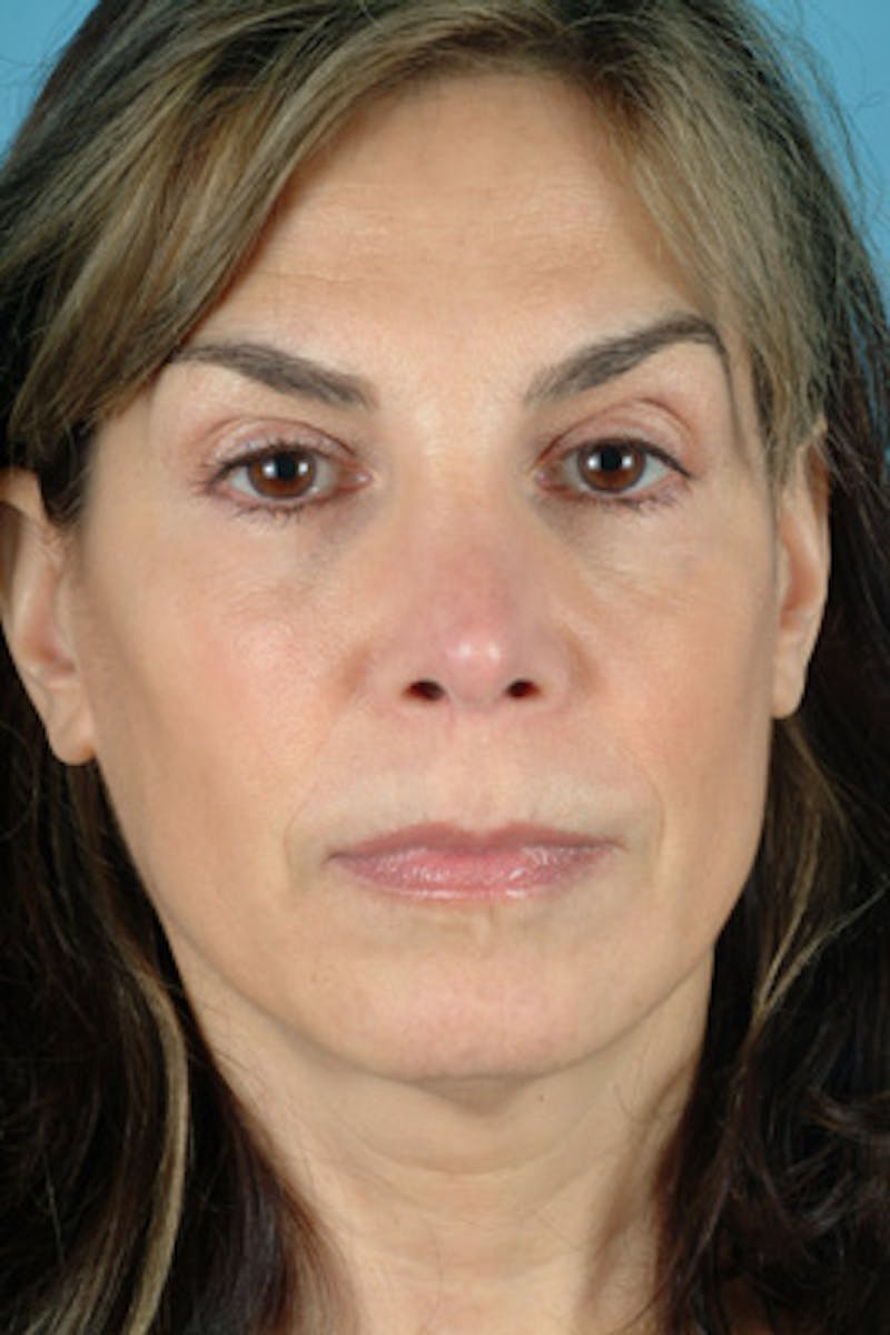 Rhinoplasty Before & After Gallery - Patient 781050 - Image 4