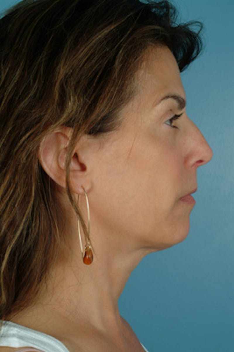 Rhinoplasty Before & After Gallery - Patient 781050 - Image 1