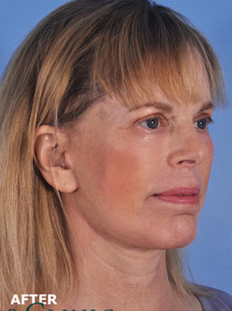 Neck Lift Before & After Gallery - Patient 380597 - Image 6