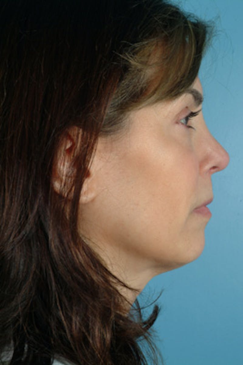 Rhinoplasty Before & After Gallery - Patient 781050 - Image 2