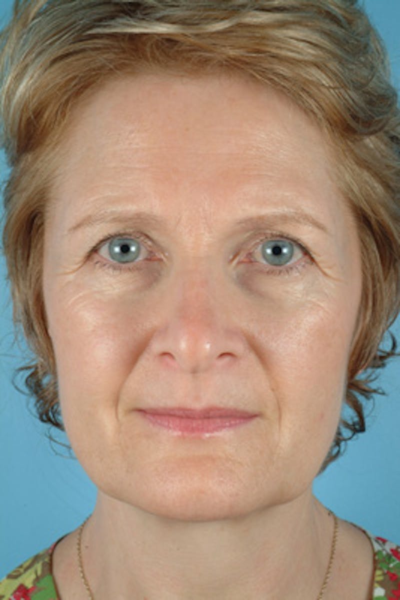Upper Blepharoplasty Before & After Gallery - Patient 182009 - Image 1