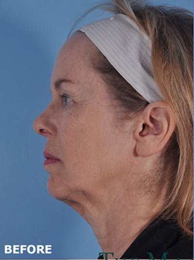 Neck Lift Before & After Gallery - Patient 380597 - Image 1