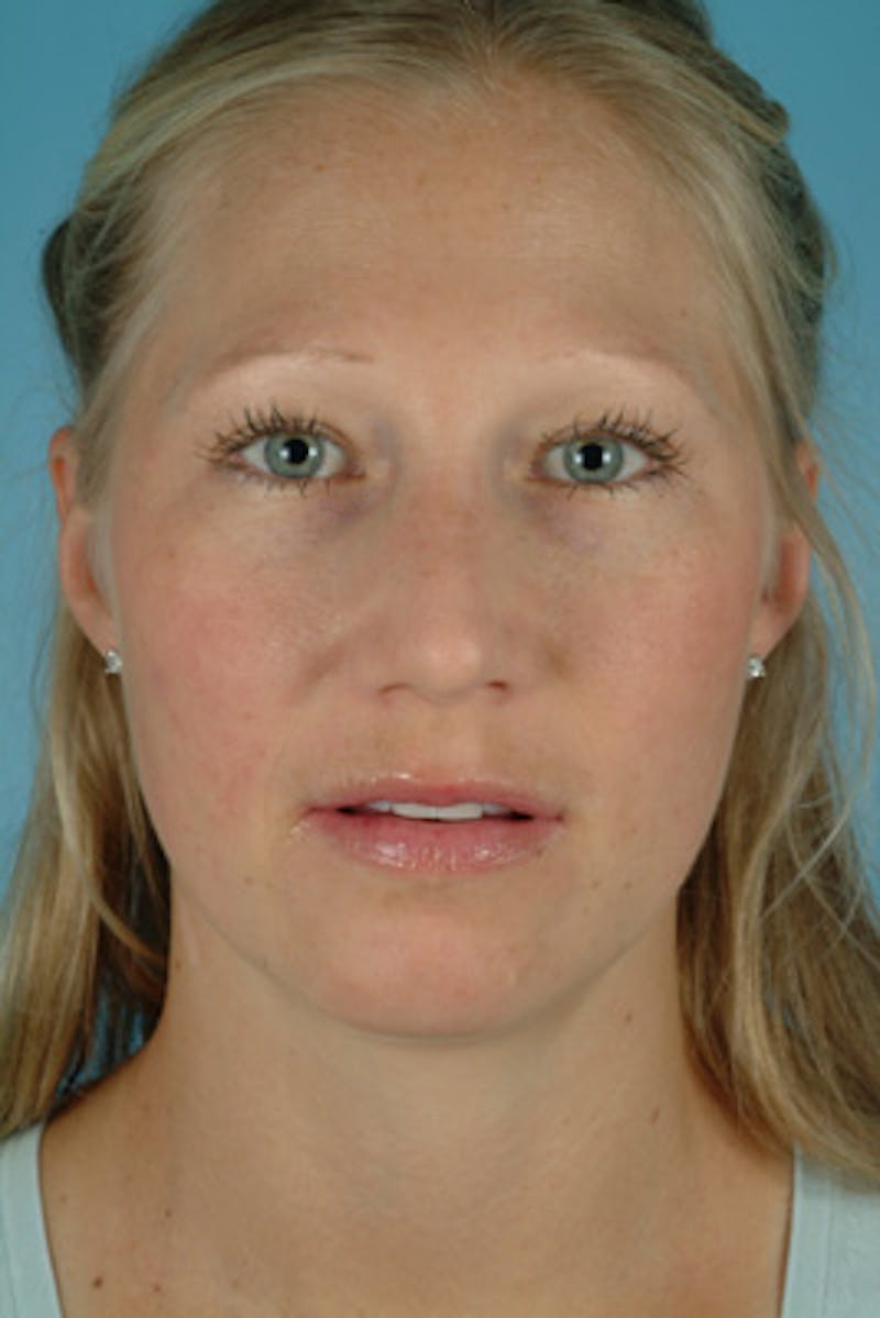 Rhinoplasty Before & After Gallery - Patient 389087 - Image 3