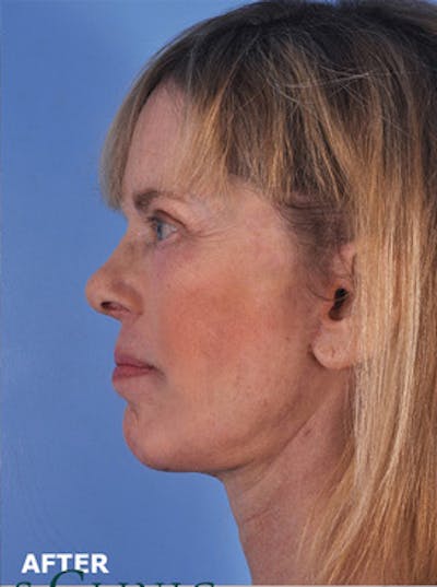 Neck Lift Before & After Gallery - Patient 380597 - Image 2