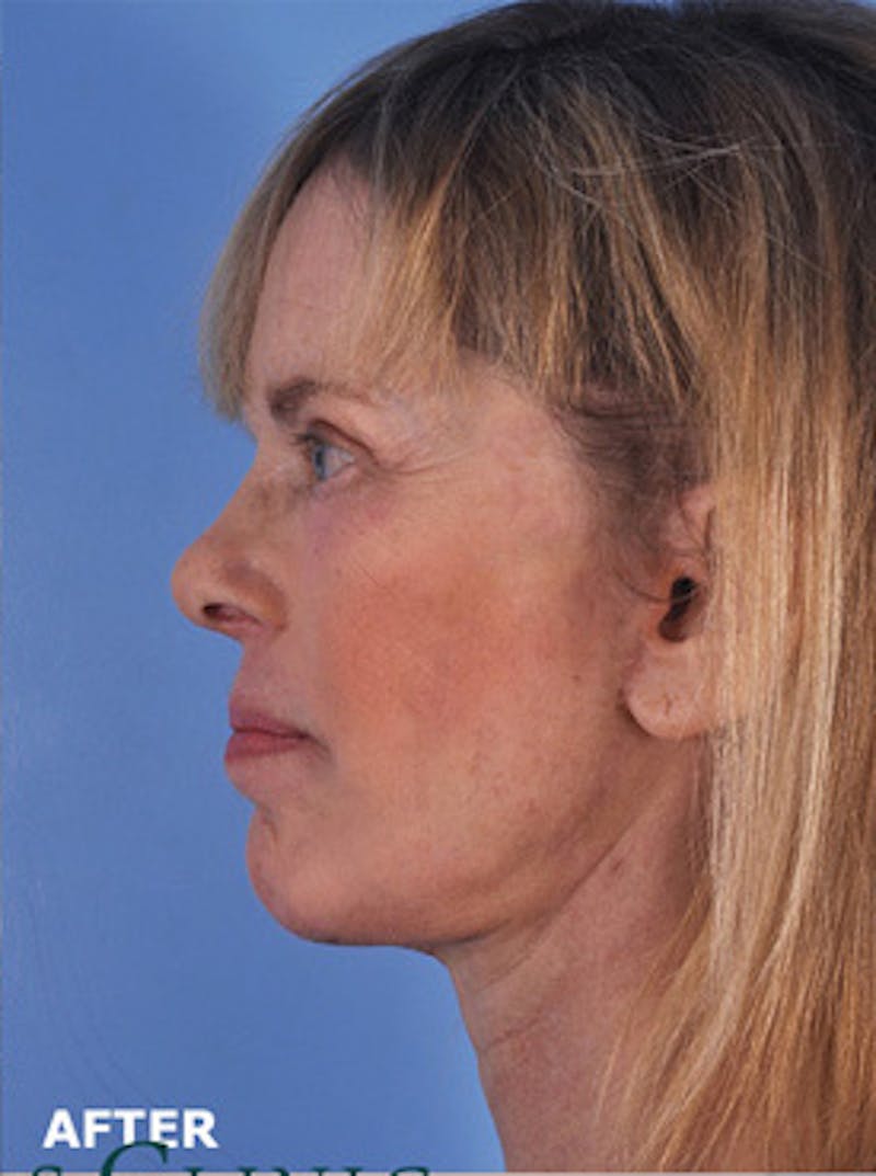 Neck Lift Before & After Gallery - Patient 380597 - Image 2