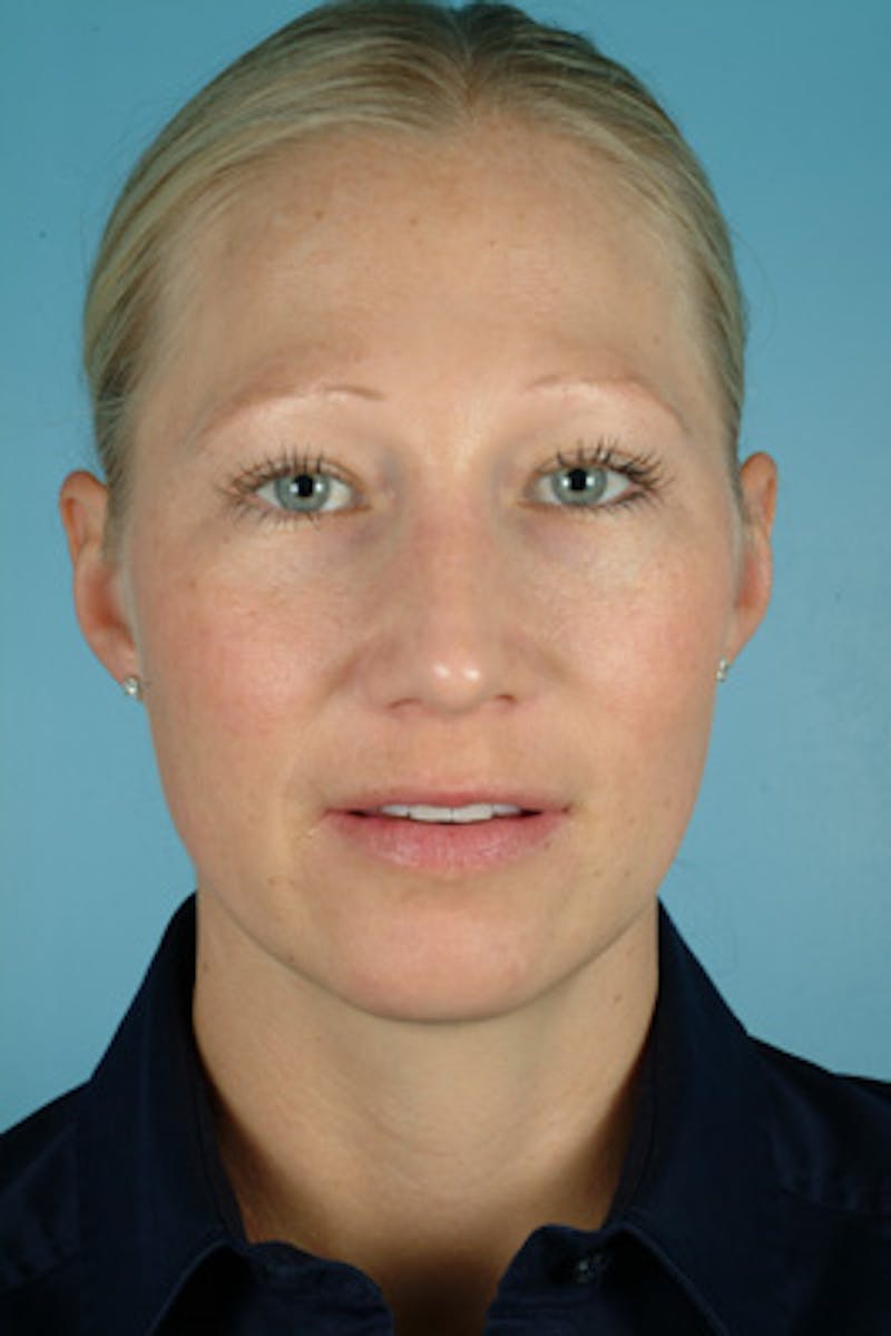 Rhinoplasty Before & After Gallery - Patient 389087 - Image 4