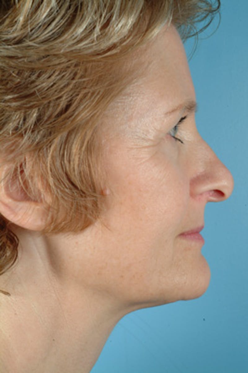 Upper Blepharoplasty Before & After Gallery - Patient 182009 - Image 3