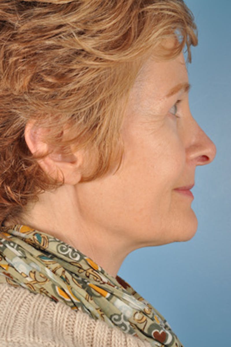 Upper Blepharoplasty Before & After Gallery - Patient 182009 - Image 4