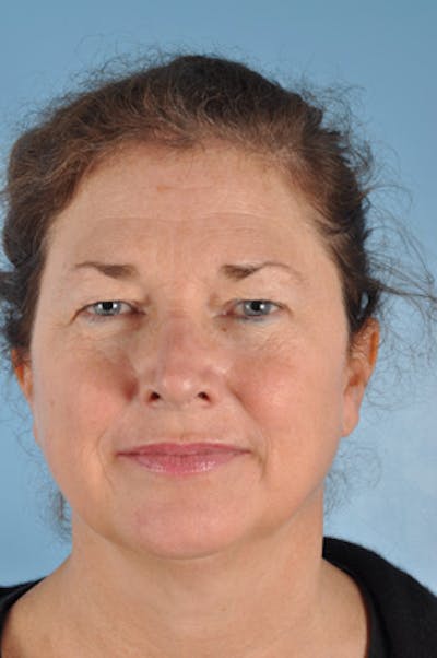 Upper Blepharoplasty Before & After Gallery - Patient 142704 - Image 1