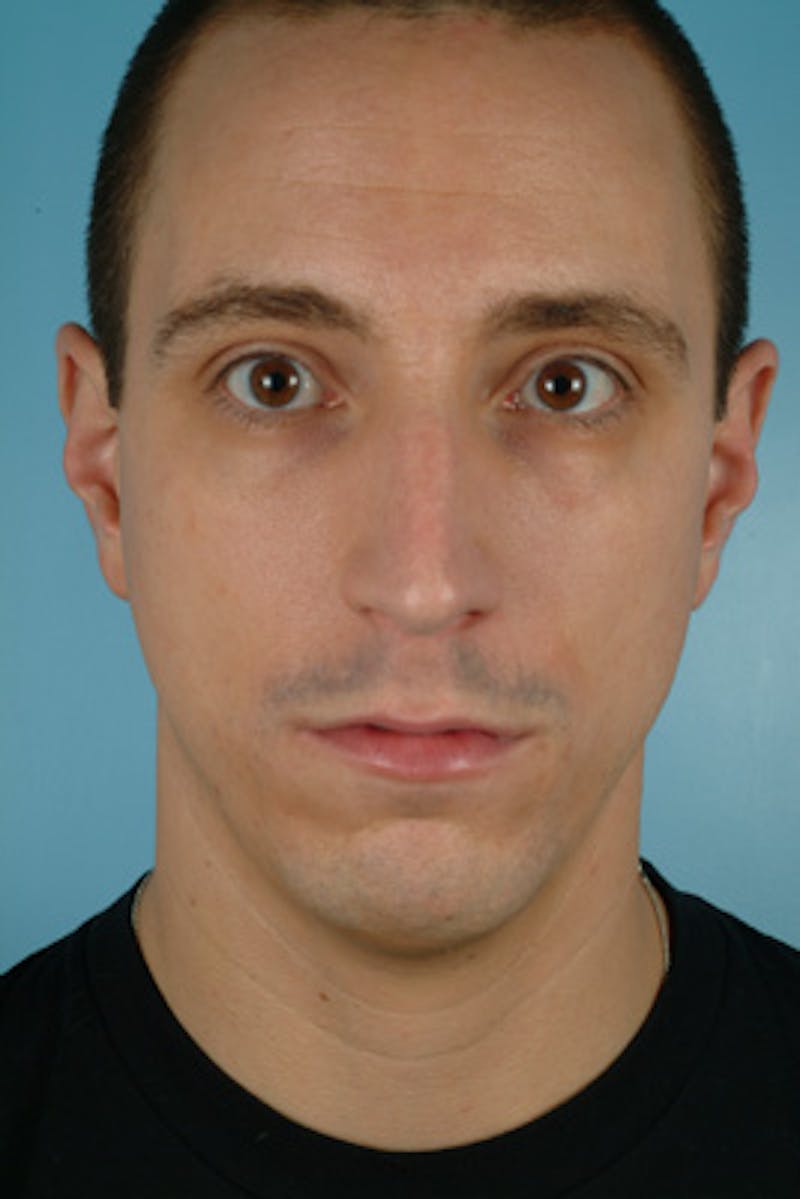 Rhinoplasty Before & After Gallery - Patient 372729 - Image 3