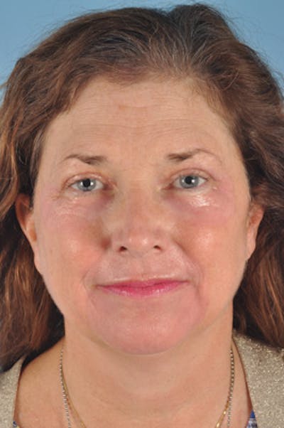 Upper Blepharoplasty Before & After Gallery - Patient 142704 - Image 2