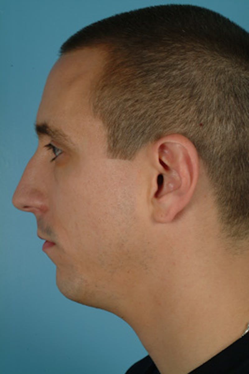 Rhinoplasty Before & After Gallery - Patient 372729 - Image 1