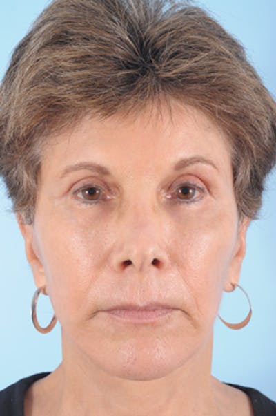 Upper Blepharoplasty Before & After Gallery - Patient 223978 - Image 2