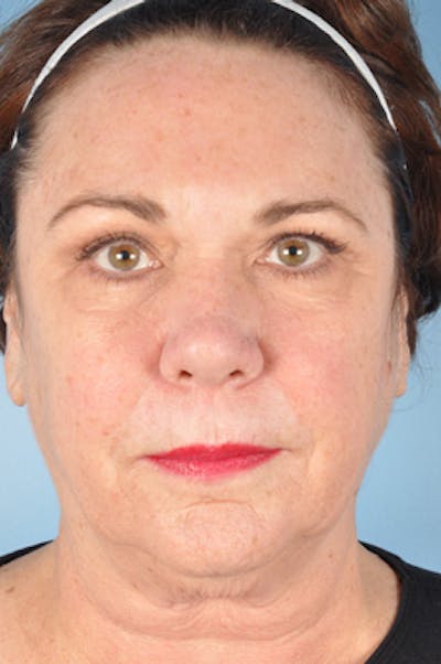 Neck Lift Before & After Gallery - Patient 430517 - Image 1