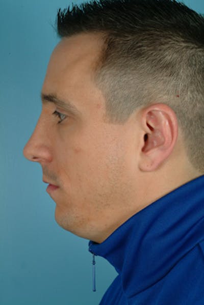Rhinoplasty Before & After Gallery - Patient 372729 - Image 2