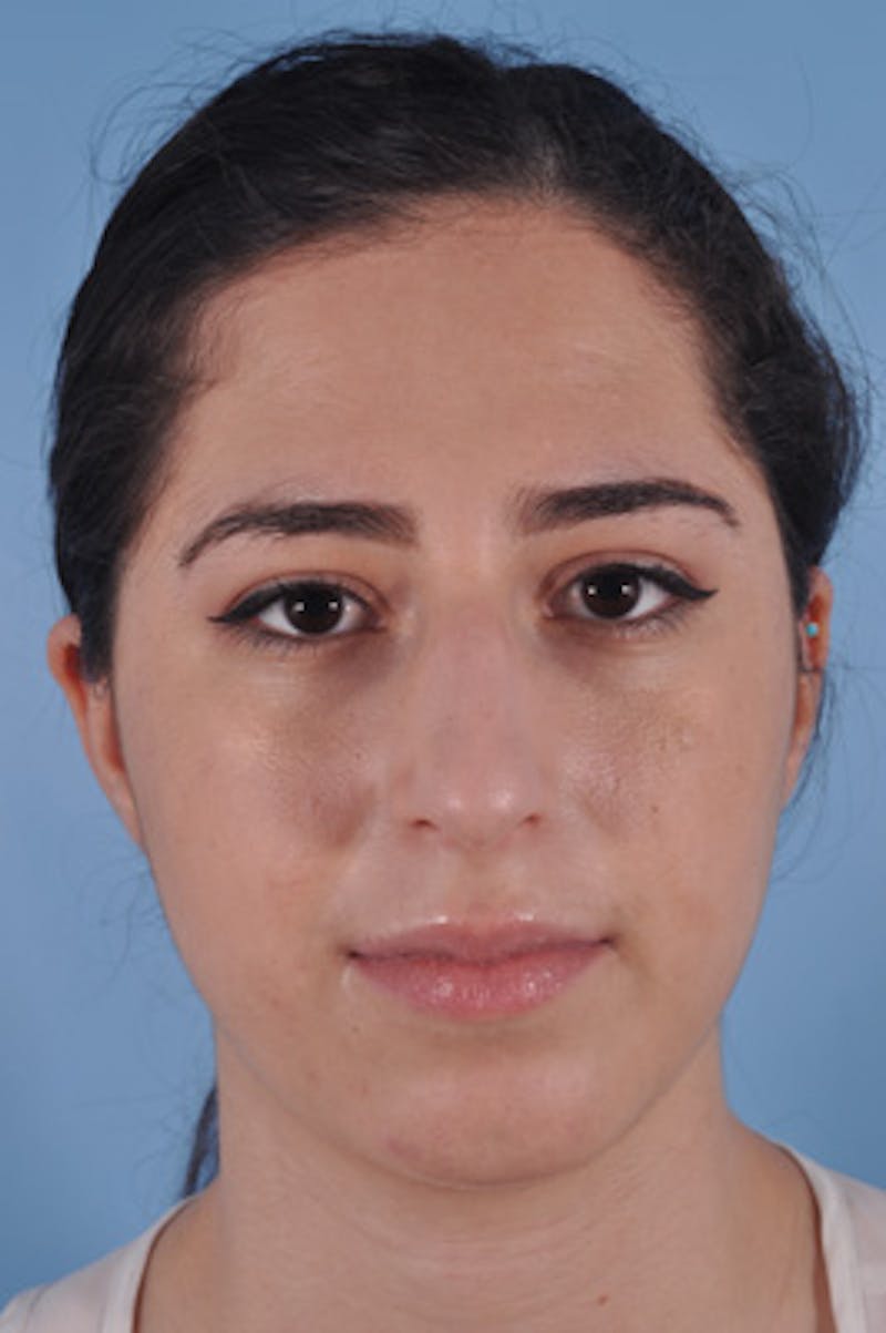 Rhinoplasty Before & After Gallery - Patient 734987 - Image 3