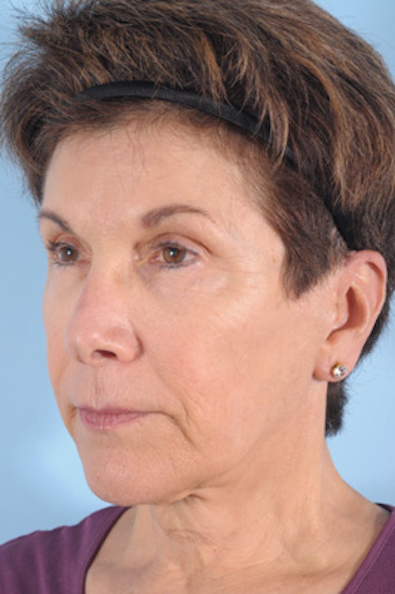 Upper Blepharoplasty Before & After Gallery - Patient 223978 - Image 5