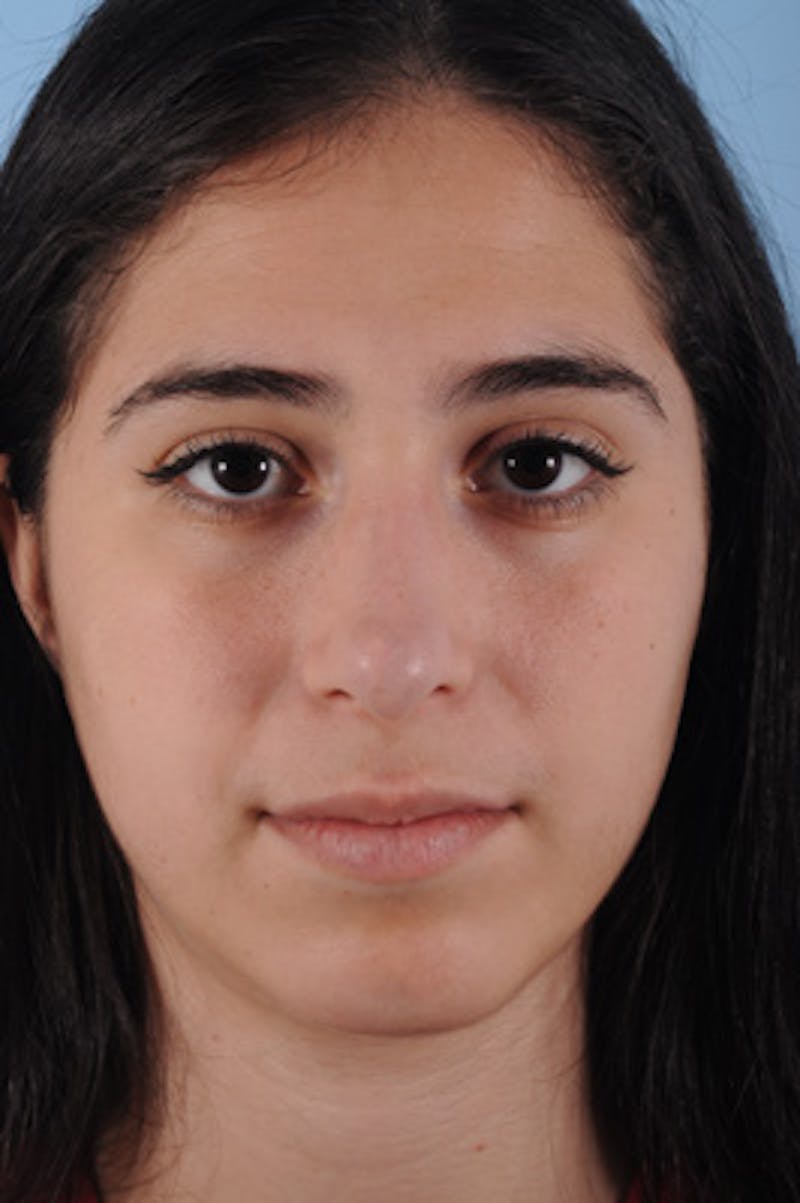 Rhinoplasty Before & After Gallery - Patient 734987 - Image 4