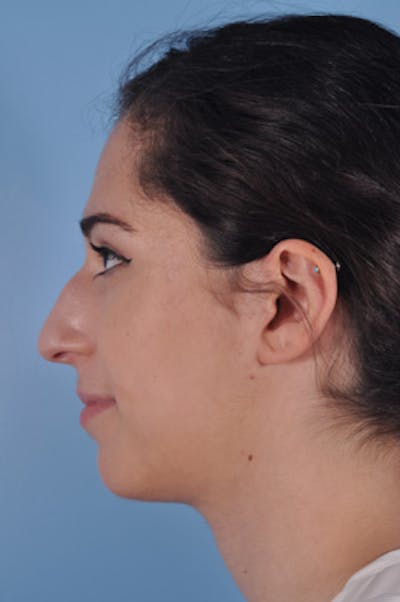 Rhinoplasty Before & After Gallery - Patient 734987 - Image 1