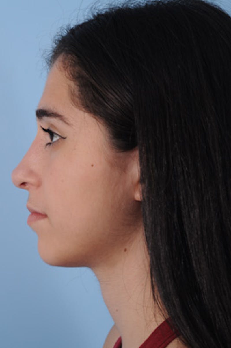Rhinoplasty Before & After Gallery - Patient 734987 - Image 2