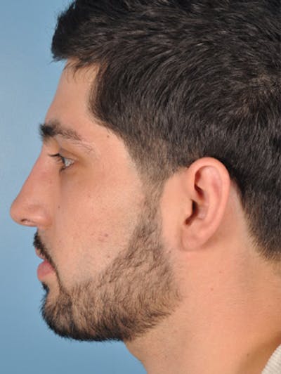 Rhinoplasty Before & After Gallery - Patient 375889 - Image 1