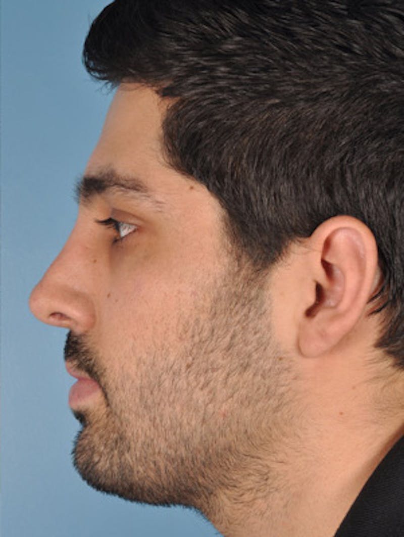 Rhinoplasty Before & After Gallery - Patient 375889 - Image 2