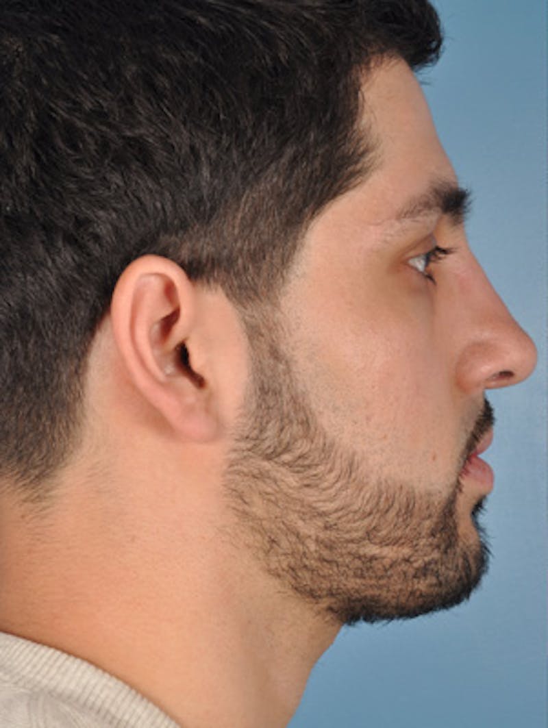 Rhinoplasty Before & After Gallery - Patient 375889 - Image 3