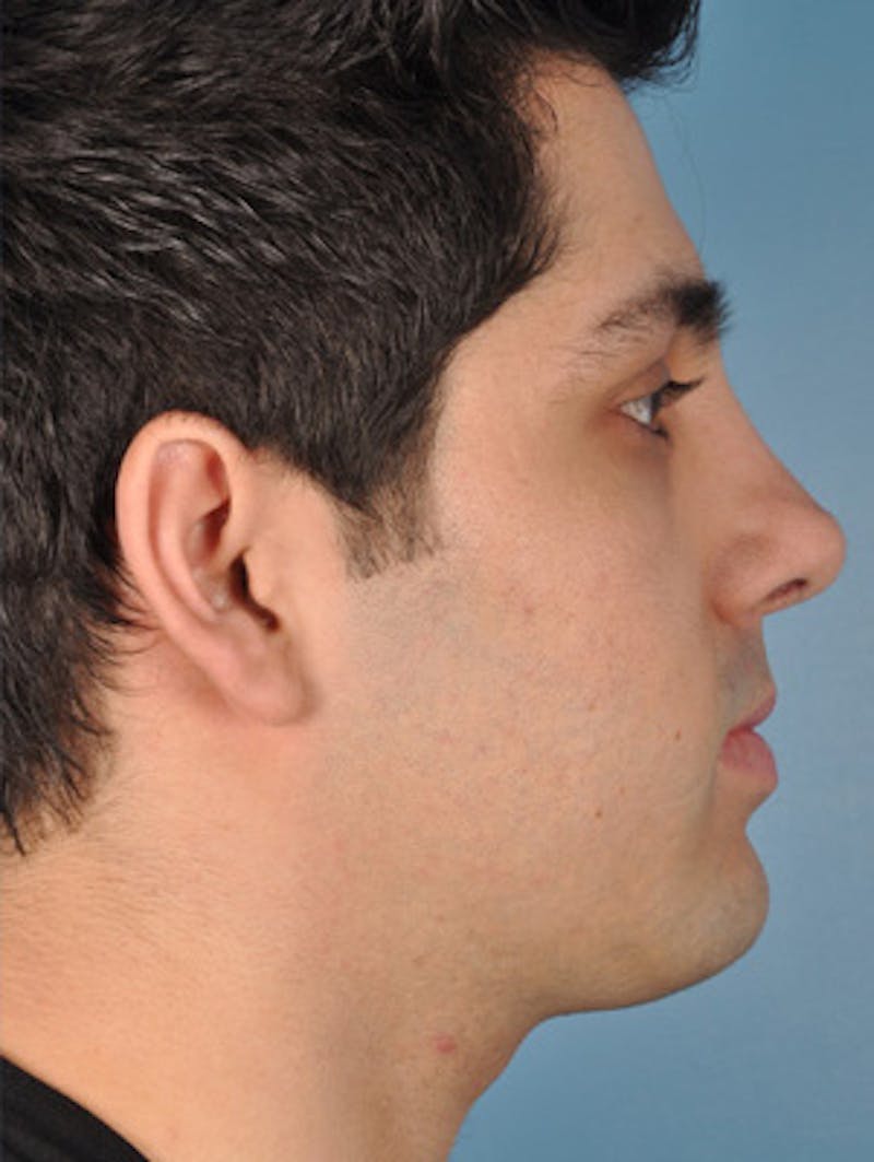 Rhinoplasty Before & After Gallery - Patient 375889 - Image 4