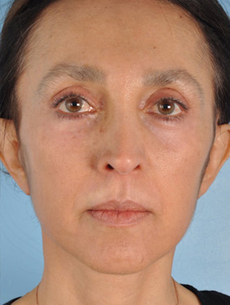 Neck Lift Before & After Gallery - Patient 105866 - Image 4