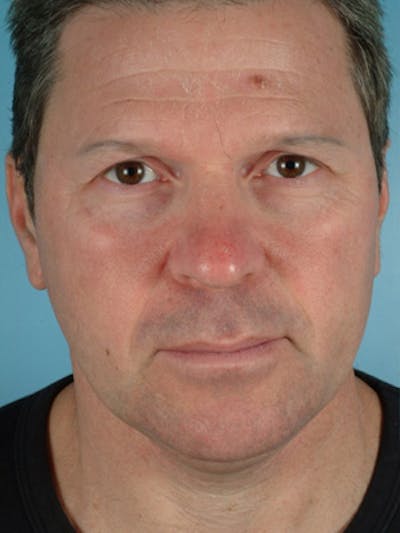 Upper Blepharoplasty Before & After Gallery - Patient 226784 - Image 1