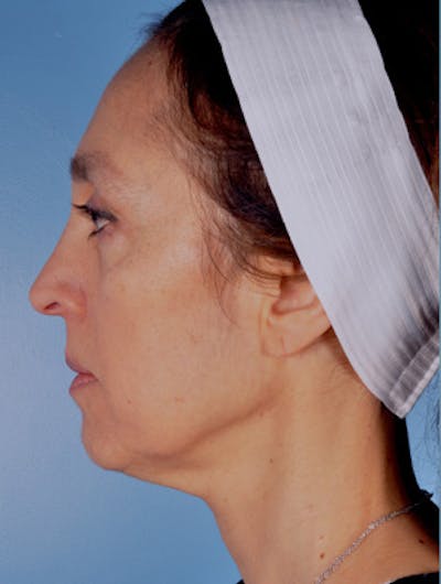 Neck Lift Before & After Gallery - Patient 105866 - Image 1