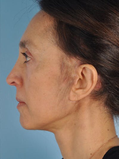 Neck Lift Before & After Gallery - Patient 105866 - Image 2