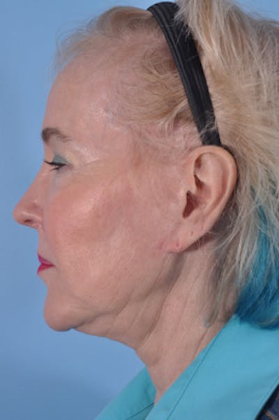 Neck Lift Before & After Gallery - Patient 159014 - Image 1
