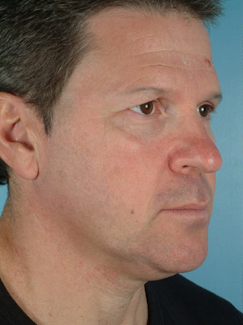 Upper Blepharoplasty Before & After Gallery - Patient 226784 - Image 5